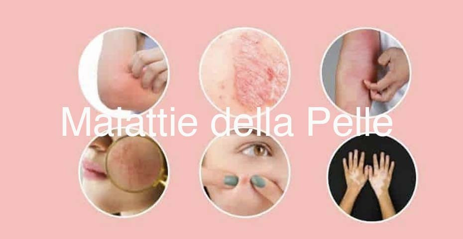 Malattie della Pelle